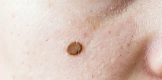 Flat mole removal on face showing a brown pigmented spot on cheek skin