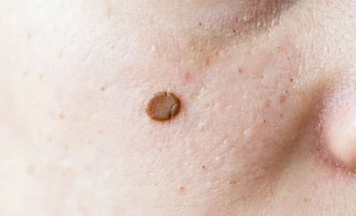 Flat Mole Removal — Brown Pigmented Spot on Face Flat mole removal on face showing a brown pigmented spot on cheek skin