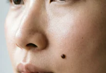 How to Remove Beauty Marks Safely: Home & Clinic Guide A woman's cheek showing a beauty mark — how to remove beauty marks safely