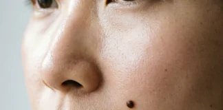A woman's cheek showing a beauty mark — how to remove beauty marks safely