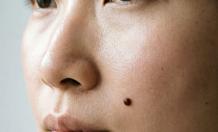 How to Remove Beauty Marks Safely at Home A woman's cheek showing a beauty mark — how to remove beauty marks safely