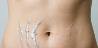 laser stretch mark removal results on abdomen showing faded marks and smoother skin texture