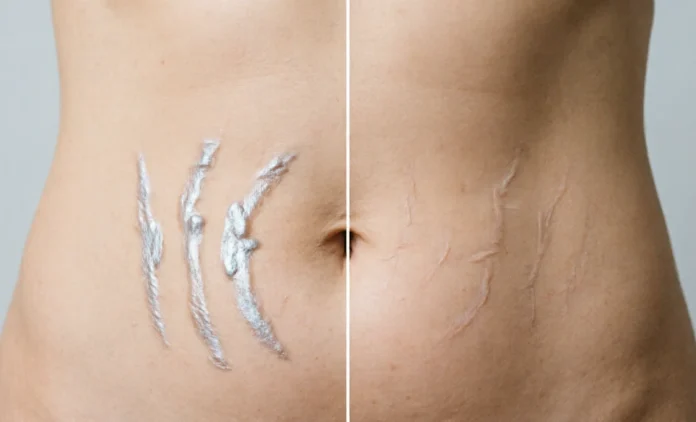 Laser Stretch Mark Removal – Before and After Results laser stretch mark removal results on abdomen showing faded marks and smoother skin texture
