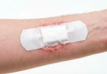 Mole Removal Healing Stages: A Day-by-Day Aftercare Guide with Vaseline Close-up of a fresh wound showing mole removal healing stages in the first 24 hours after procedure.