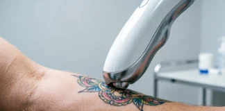 PicoWay tattoo removal laser handpiece targeting ink on forearm skin