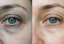 PRP for Under Eyes: Benefits, Cost, and What to Expect Before and after results of PRP for under eyes showing reduced dark circles and improved skin texture under natural lighting