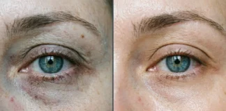Before and after results of PRP for under eyes showing reduced dark circles and improved skin texture under natural lighting