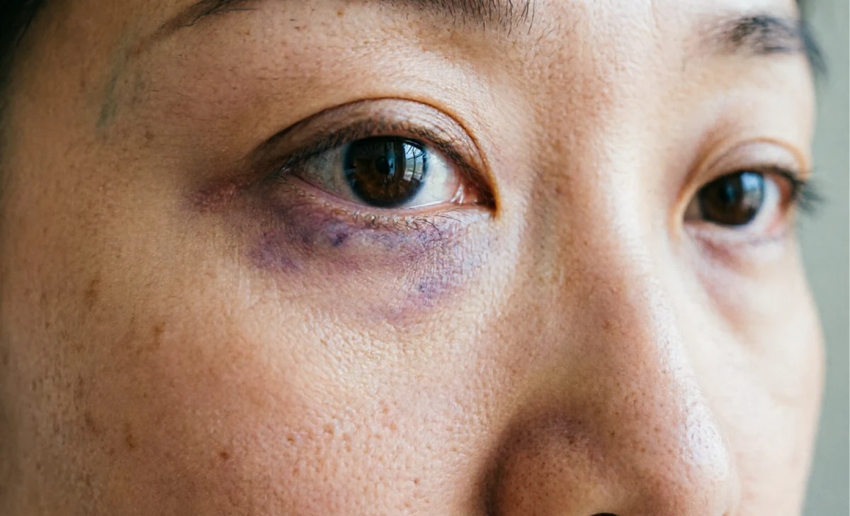 Close-up of under-eye area showing normal day three bruising and swelling during PRP for under eyes recovery